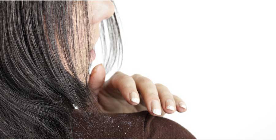 how to remove dandruff on hair